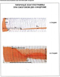 Таблица №9: Типичные коагулограммы при ожоговом ДВС-синдроме