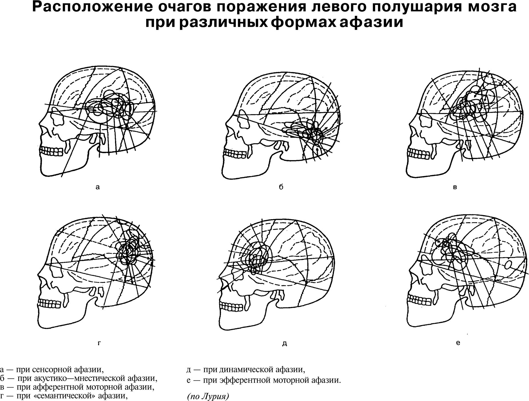 Расположение очагов поражения левого полушария мозга при различных формах афазии