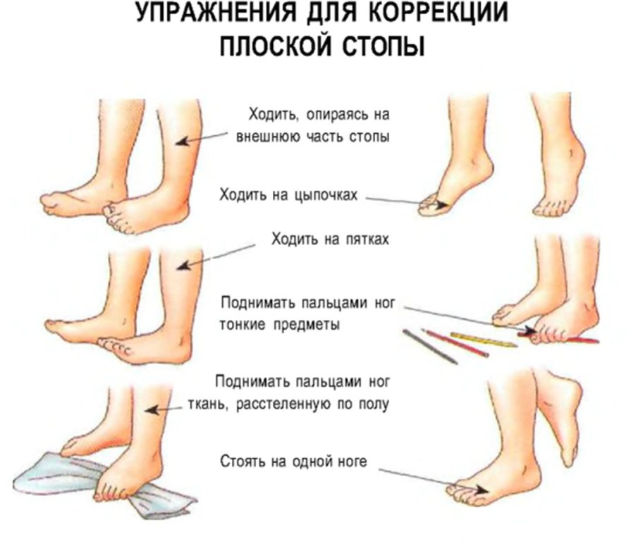 Упражнения для коррекции плоской стопы