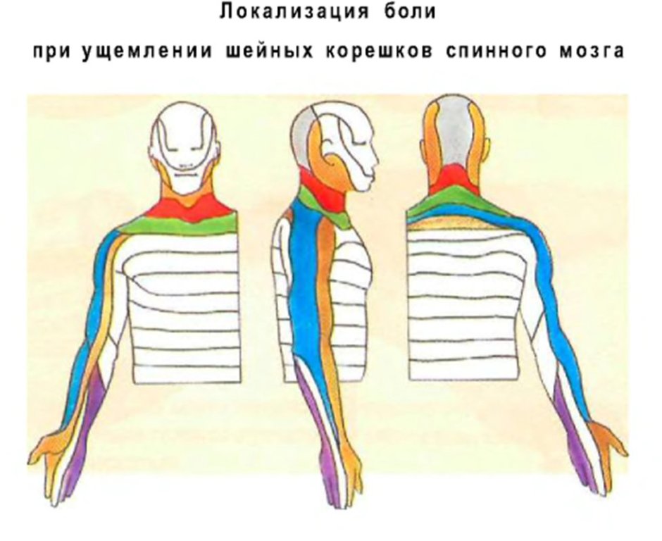 Локализация боли при ущемлении шейных корешков спинного мозга