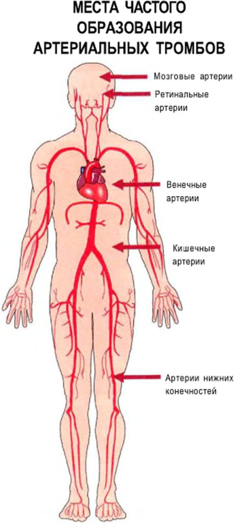 Места частого образования артериальных тромбов