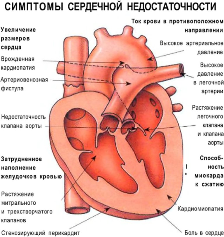 Симптомы сердечной недостаточности